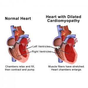 800px-Blausen_0165_Cardiomyopathy_Dilated-thumb-300×300