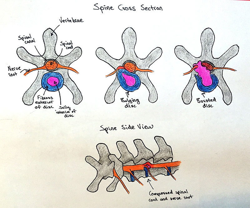 IVDD Dachshund Diagram. Intervertebral disc disease (IVDD) in dogs. IVDD in dogs. Cervical and thoracolumbar regions