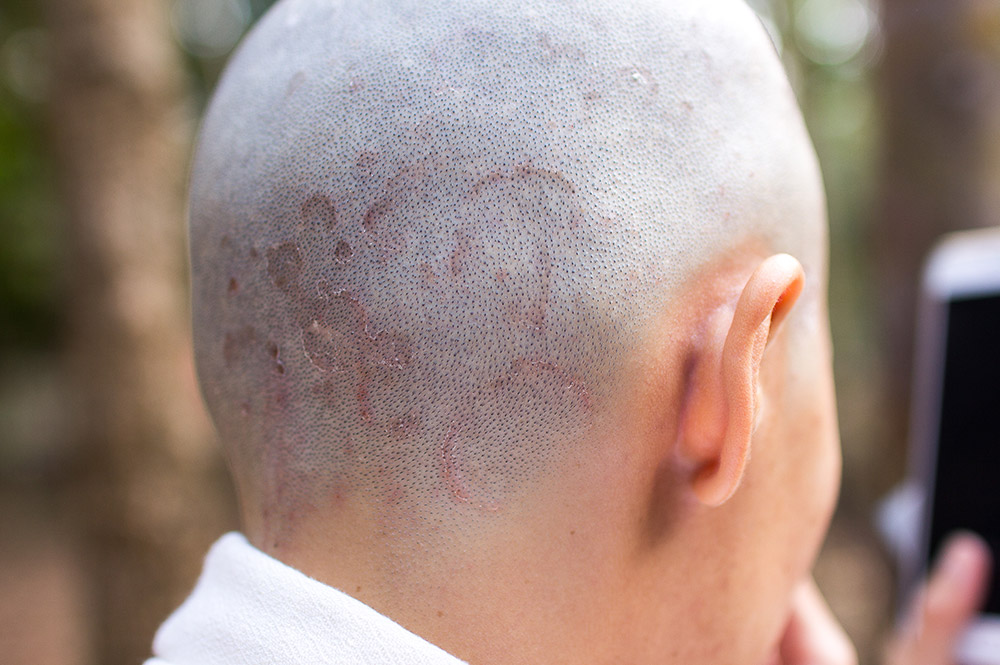 ringworm on human scalp